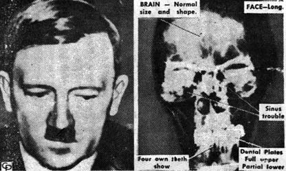 ヒトラーの頭のレントゲン写真